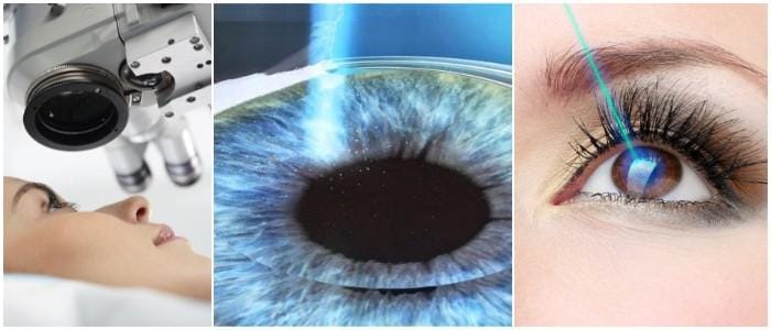 que es la cirugía refractiva bilateral
