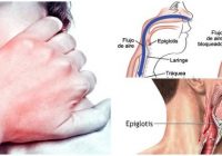 epiglotis enfermedades