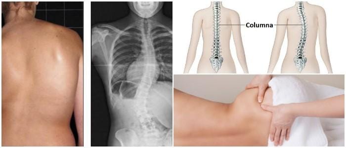 que es la escoliosis lumbar