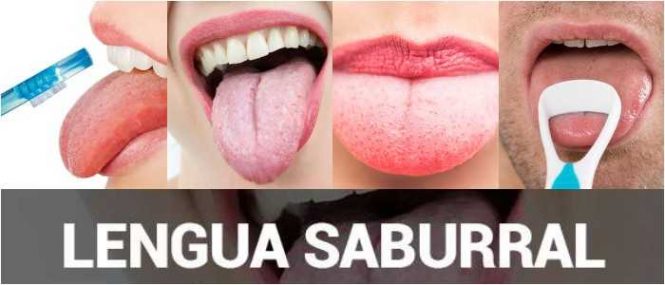 que es una lengua saburral blanca