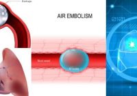 que es la embolia gaseosa arterial