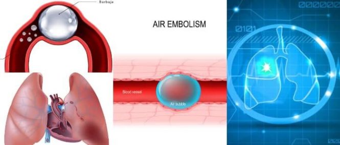 que es la embolia gaseosa arterial