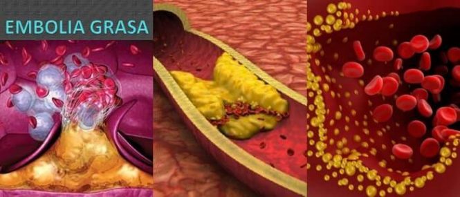 criterios de un embolismo graso