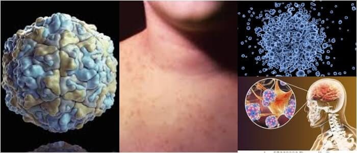 que son las enfermedades por echovirus