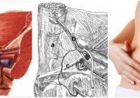 cuales son las consecuencias de una hernia en el triangulo de hesselbach