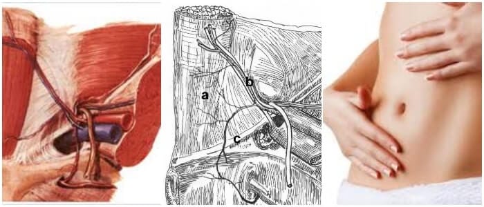 cuales son las consecuencias de una hernia en el triangulo de hesselbach
