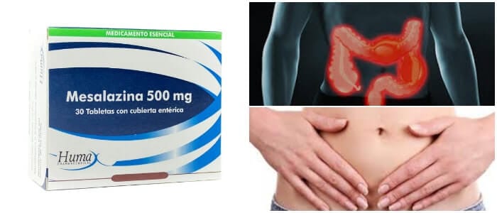 la mesalazina para la colitis ulcerosa