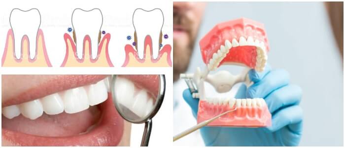ligamento periodontal