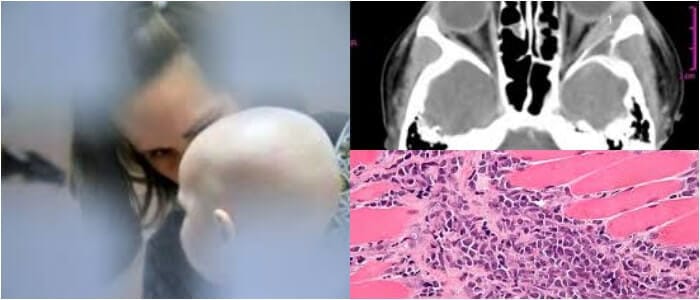 sarcoma granulocitico
