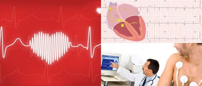 contracciones ventriculares prematuras