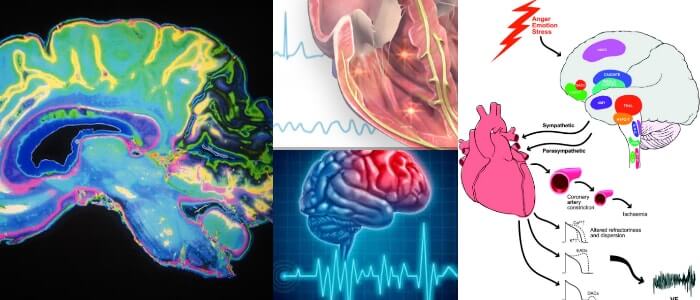 disritmia cerebral