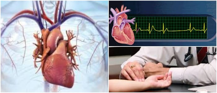 taquicardia supraventricular