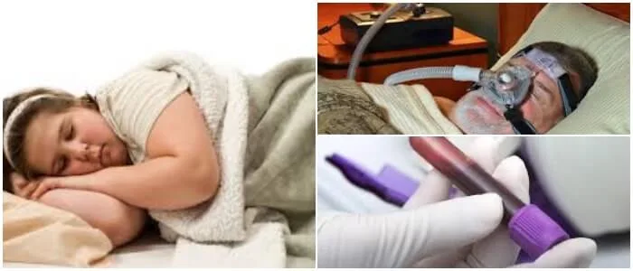 sindrome de hipoventilacion y obesidad