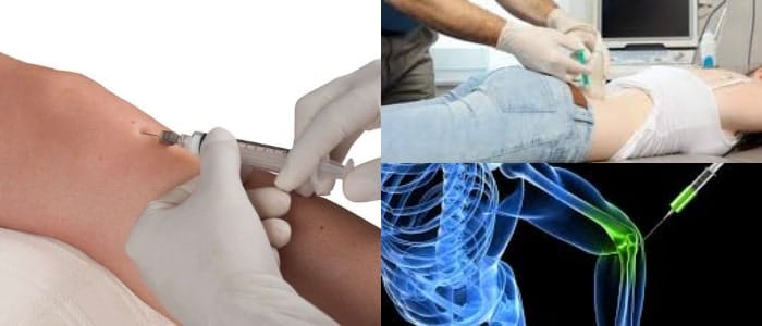 osteoartritis